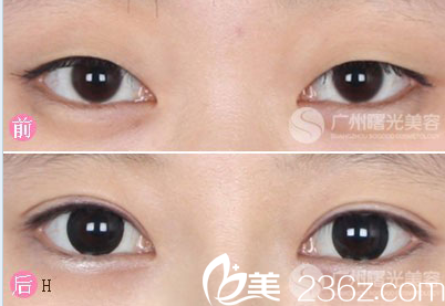 廣州曙光王娟雙眼皮前后對比案例