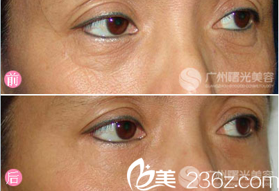 廣州曙光王娟祛眼袋案例