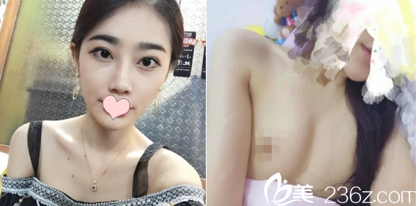 隆胸術(shù)前自拍 隆胸術(shù)前自拍