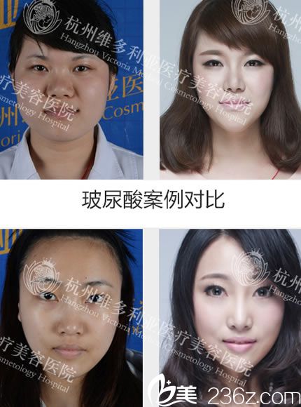 方葉琴醫(yī)生注射玻尿酸案例圖