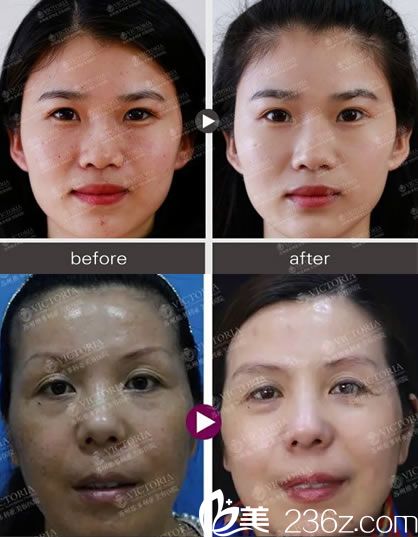 鐘鋒醫(yī)生的祛斑美白案例 鐘鋒醫(yī)生的祛斑美白案例