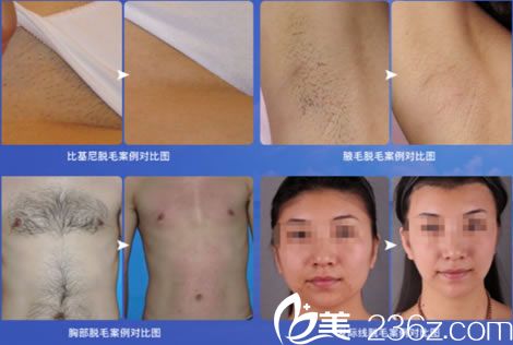 王婷婷醫(yī)生的脫毛案例圖 王婷婷醫(yī)生的脫毛案例圖