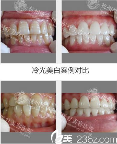 洪超醫(yī)生做的牙齒美白<span style=
