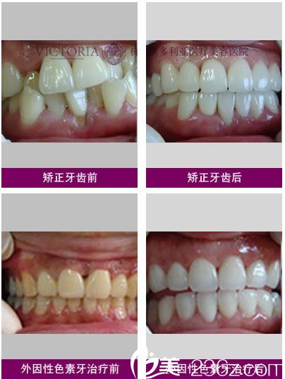 黃仁輝醫(yī)生的牙齒矯正手術(shù)案例 黃仁輝醫(yī)生的牙齒矯正手術(shù)案例