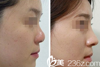 陳玉連隆鼻整形案例 陳玉連隆鼻整形案例