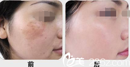 林麗蓉醫(yī)生皮膚整形案例 林麗蓉醫(yī)生皮膚整形案例