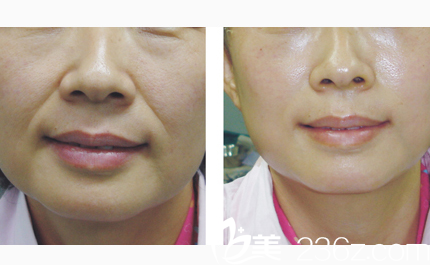 法令紋治療前——韓國will醫(yī)院