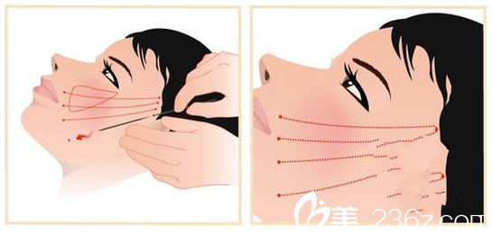 韓國will整形外科—埋線提升