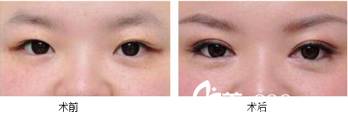北京葉子魯禮新埋線雙眼皮修復(fù)案例