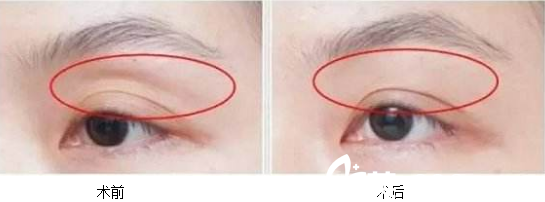 北京葉子魯禮新雙眼皮過(guò)寬+眼部凹陷及溝深修復(fù)案例
