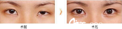 北京葉子魯禮新雙眼皮兩側(cè)不對(duì)稱修復(fù)案例