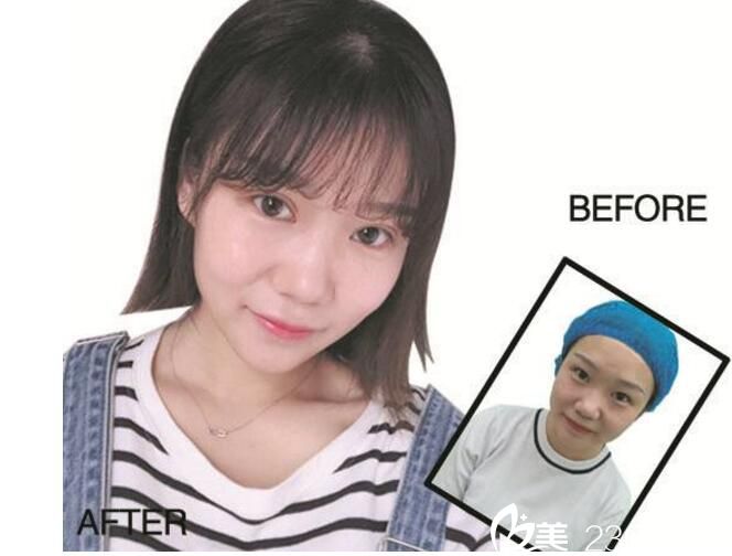 易院玲 雙眼皮手術(shù)對(duì)比圖 易院玲 雙眼皮手術(shù)對(duì)比圖