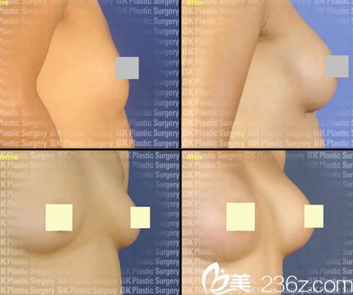 琴仁燮院長的胸部整形案例