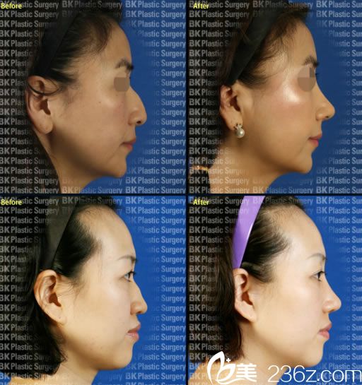 高殷錫院長的鷹鉤鼻矯正案例 高殷錫院長的鷹鉤鼻矯正案例