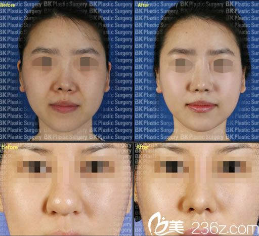 高殷錫院長鼻修復(fù)案例 高殷錫院長鼻修復(fù)案例