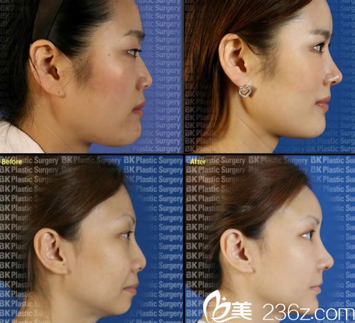 高殷錫院長隆鼻手術(shù)案例 高殷錫院長隆鼻手術(shù)案例