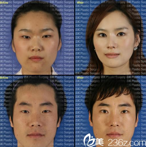 都彥祿院長的切開法雙眼皮案例 都彥祿院長的切開法雙眼皮案例