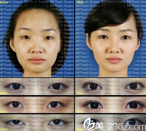 埋線法雙眼皮案例 埋線法雙眼皮案例