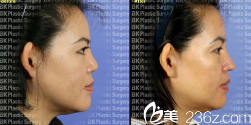 姜相求院長短鼻矯正案例 姜相求院長短鼻矯正案例