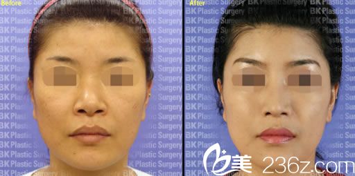 姜相求院長假體隆鼻案例 姜相求院長假體隆鼻案例