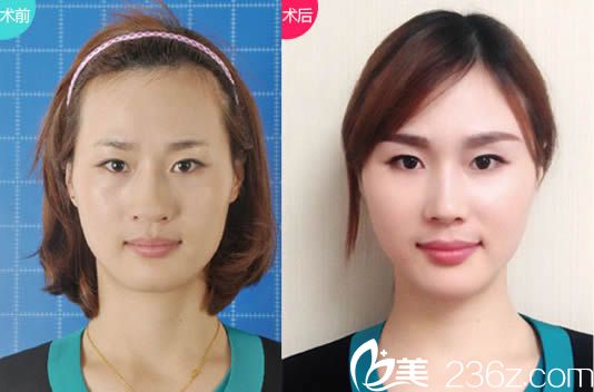 張敏自體脂肪填充案例圖