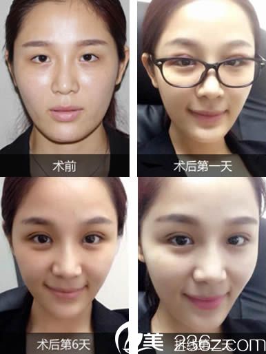 林平醫(yī)生雙眼皮案例圖