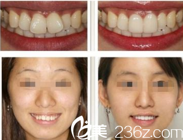 太原時光白麗鵬醫(yī)生牙齒正畸真人案例 太原時光白麗鵬醫(yī)生牙齒正畸真人案例