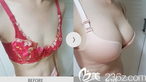 <!--<i data=20240703-sp></i>-->金光善醫(yī)生假體隆胸手術(shù)案例 <!--<i data=20240703-sp></i>-->金光善醫(yī)生假體隆胸手術(shù)案例