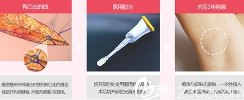 聚星醫(yī)院隆胸手術(shù)的醫(yī)生金光善隆胸術(shù)后的縫合