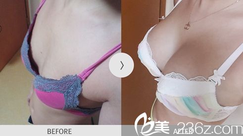 <!--<i data=20240703-sp></i>-->金光善醫(yī)生假體隆胸手術(shù)案例2