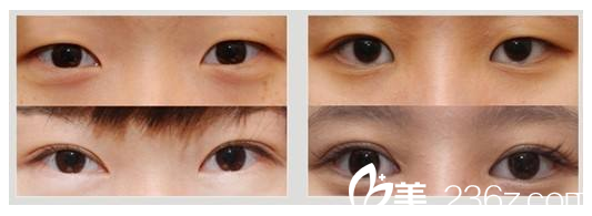 彭利濤眼部整形案例 彭利濤眼部整形案例