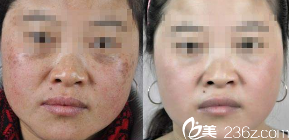 梁亮治療黃褐斑整形案例 梁亮治療黃褐斑整形案例