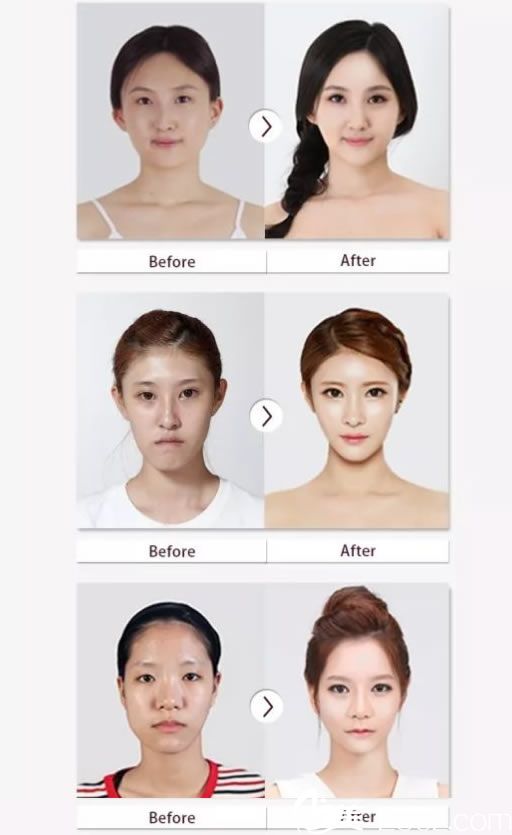 韓國BK整形案例效果圖