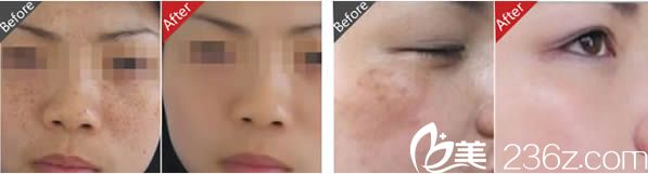 趙堅鋼祛斑案例圖