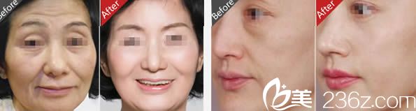 趙堅鋼院長塑美極治療效果圖