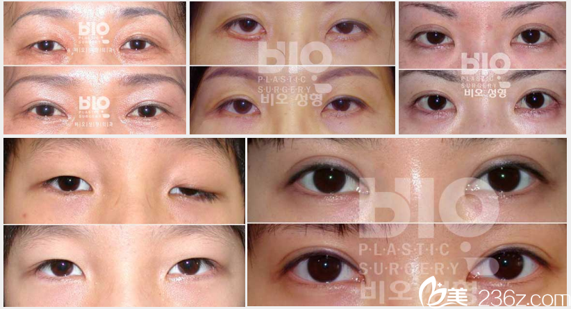 曹仁昌做雙眼皮修復(fù)怎么樣 曹仁昌做雙眼皮修復(fù)怎么樣