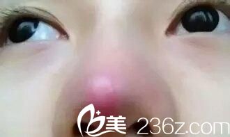 手術(shù)后鼻子為什么會發(fā)紅
