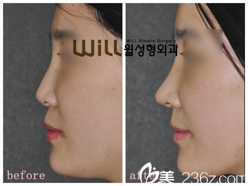 韓國will醫(yī)院隆鼻真人案例