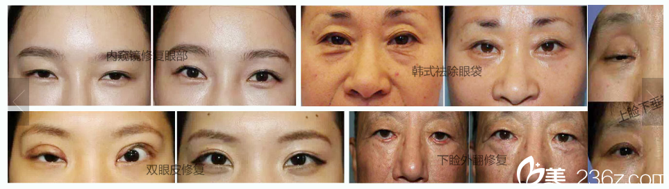洪星杓院長(zhǎng)雙眼皮+祛眼袋案例 洪星杓院長(zhǎng)雙眼皮+祛眼袋案例