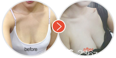 太原時光羅盛康隆胸案例對比照