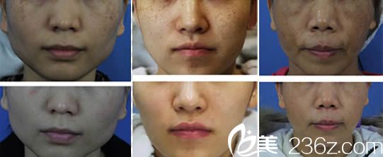 林秋蓉醫(yī)生激光祛斑案例