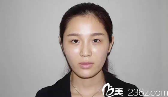 自從找福州比華利林平院長做雙眼皮+開眼角后讓我變電眼