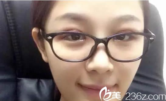 做完雙眼皮術(shù)后天的樣子