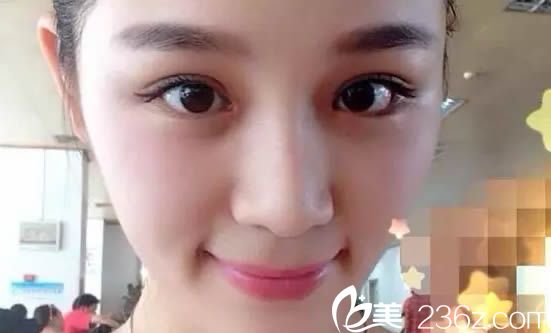 林平雙眼皮術(shù)后15天恢復(fù)效果