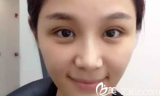 雙眼皮術(shù)后第6天拆完線的美照