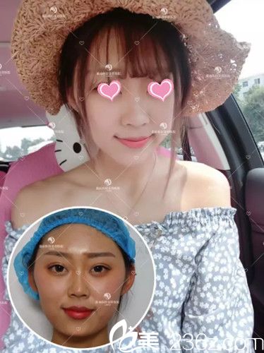 術(shù)后第2天下巴前后對(duì)比