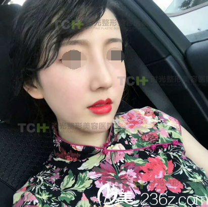 在重慶時(shí)光做DBM生態(tài)美弧隆鼻術(shù)后15天