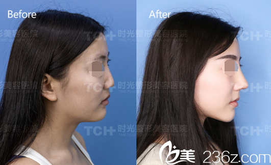 重慶時(shí)光DBM生態(tài)美弧鼻側(cè)面對(duì)比圖