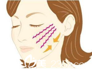 面部線雕所埋線的位置