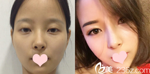 深圳美萊郭杰全面部自體脂肪填充<span style=